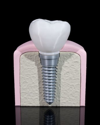Dental Implant Anatomical Model